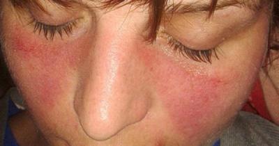 «Покраснение и шелушение вокруг носа, чем лечить? » — Яндекс Кью