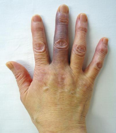 Посинение пальцев рук - причины и признаки, лечение и диагностика