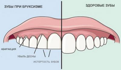 Прикусываю язык во сне