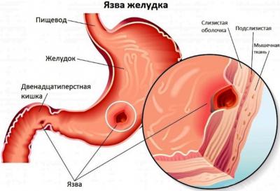 как образуется язва