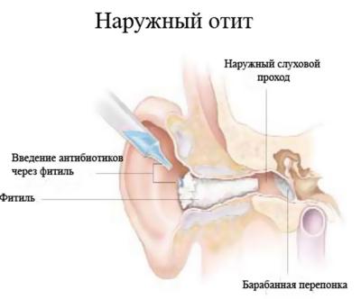 Проявления отита наглядно