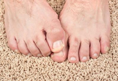 Почему ногти на ногах желтые – причины и лечение