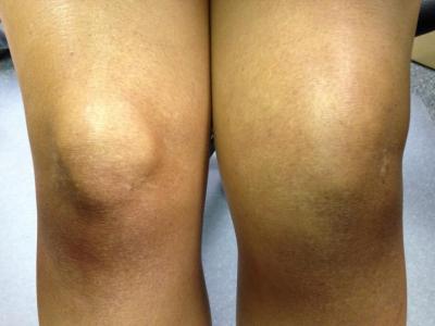bol i oticanje koljena