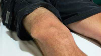 Что такое деформирующий артроз коленного сустава 2 степени thumbnail
