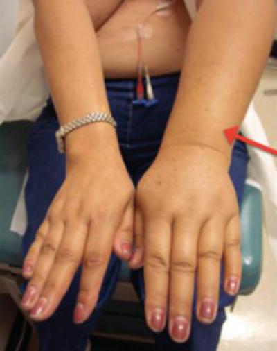 лимфостаз руки после удаления молочной железы